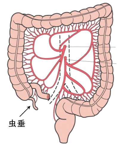 虫垂炎 急性 急性虫垂炎、慢性虫垂炎、虫垂炎、再発 ちらした虫垂炎（医師編）：中野こども病院